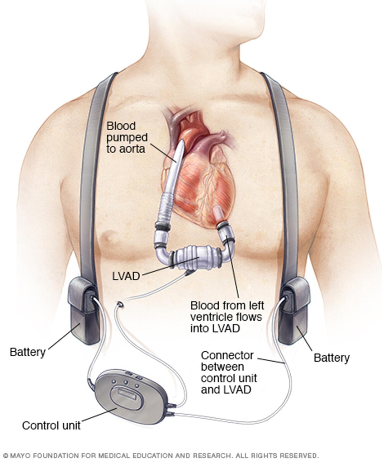 Mayo Clinic is announcing results of a study on the effectiveness of left-ventricular assist devices (LVAD) in treating patients with a form of cardiomyopathy called restricive cardiomyopathy (RCM).