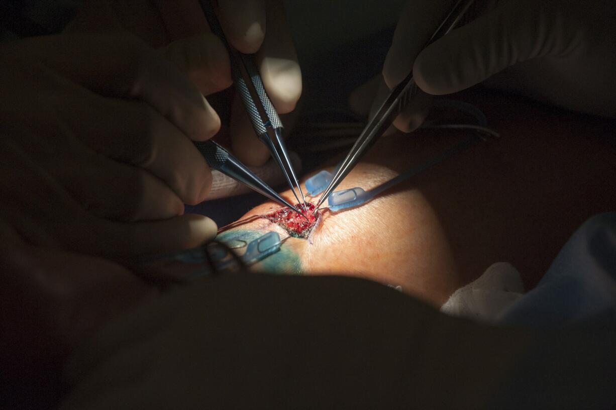 Micro-vascular plastic surgeon Dr. Manish Champaneria performs a vascularized lymph node transfer and a lymphaticovenous bypass on Carol Prather of Vancouver on April 13 at PeaceHealth Southwest Medical Center.