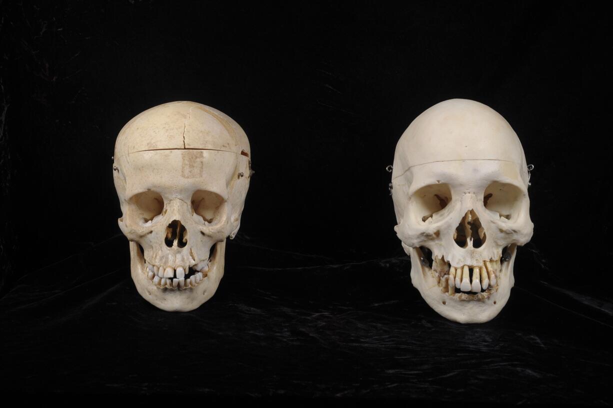 Two human skulls prepared for clinical use that were donated to a Bellevue thrift store. A third, older skull from a Native American child, not pictured, was also donated.