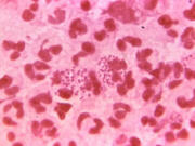 A microscopic view of gonorrhea.