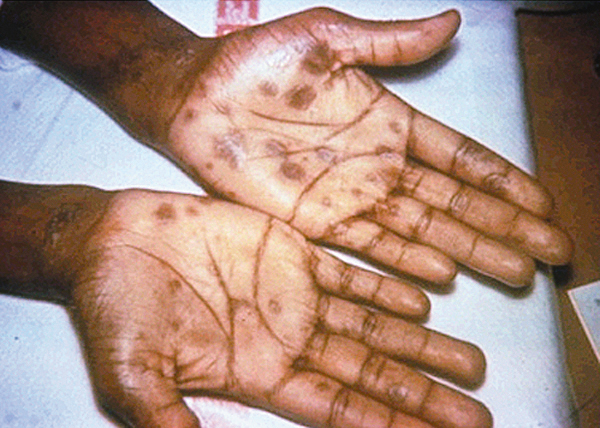 Secondary syphilis -- the second phase of the disease -- usually begins with a reddish-brown, spotted rash on one or more parts of the body, most often on the palms of the hands or soles of the feet.