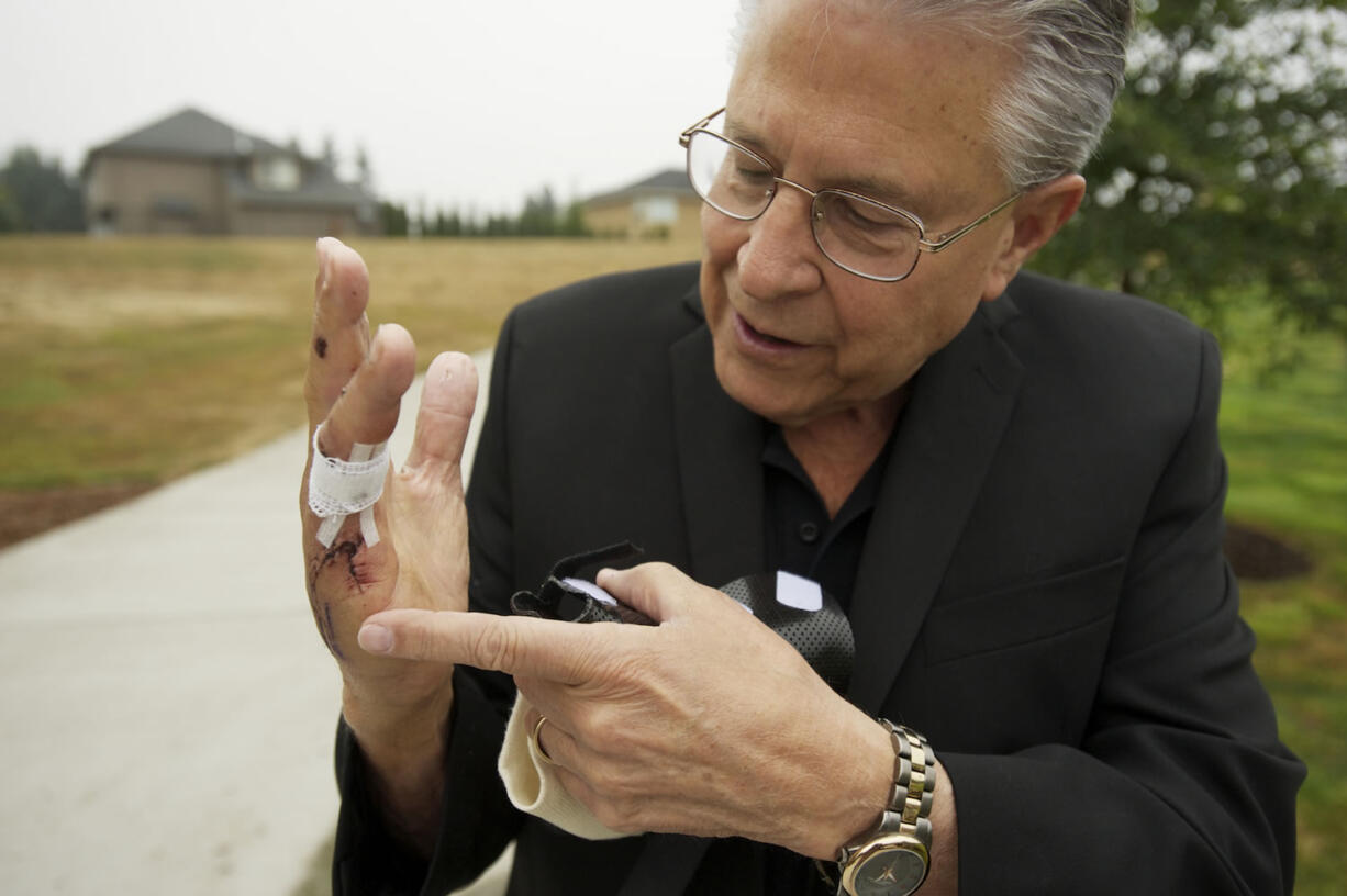 Doctors removed what was left of Gerry Matthieu's right pinky finger after a dog bit it off earlier this month.