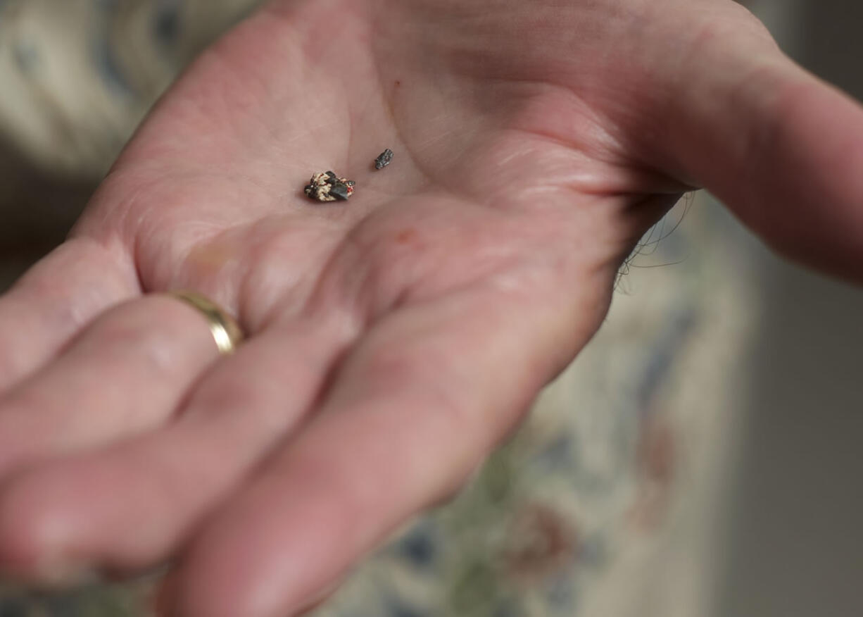 Carl Wunder displays two bullet fragments that were removed Tuesday from his right arm, where they had been since May 3, 1945.