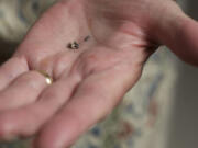 Carl Wunder displays two bullet fragments that were removed Tuesday from his right arm, where they had been since May 3, 1945.