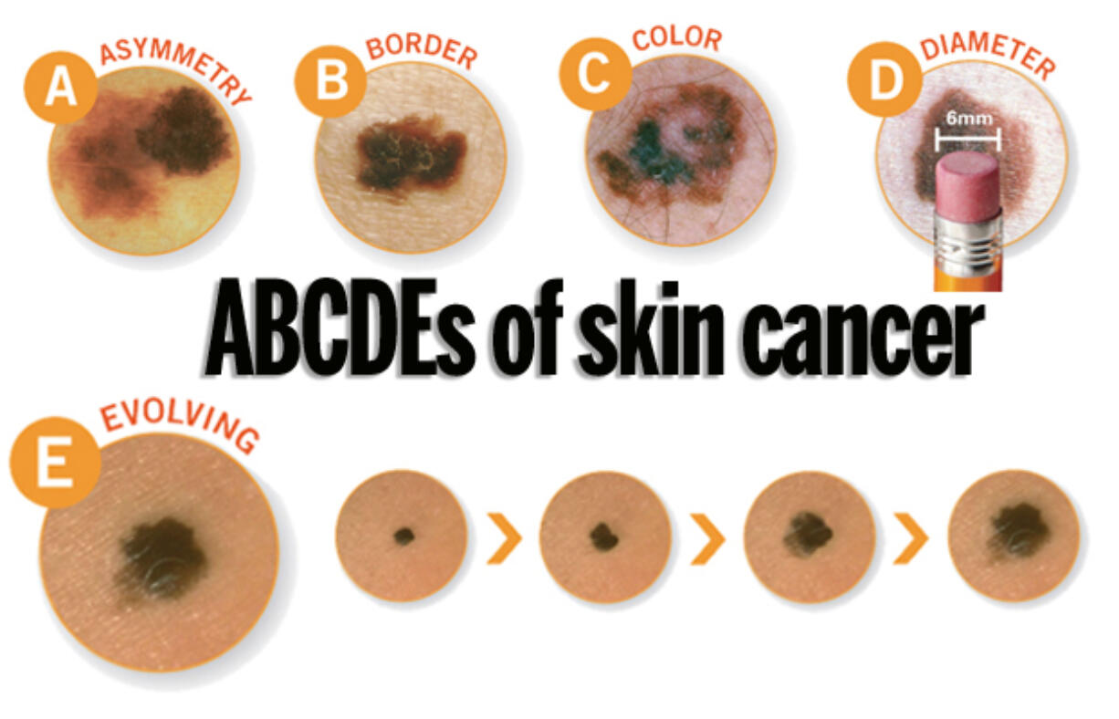 The American Academy of Dermatologists recommends using the ABCDEs of Melanoma Detection (asymmetry, border, color, diameter, evolving) when checking your skin.