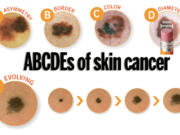 The American Academy of Dermatologists recommends using the ABCDEs of Melanoma Detection (asymmetry, border, color, diameter, evolving) when checking your skin.