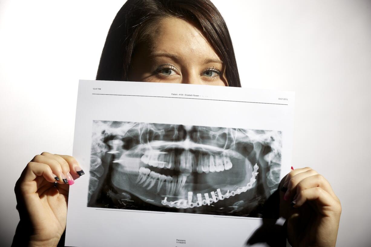 Liz Rowan, 21, holds a panoramic x-ray of her jaw Wednesday  in Vancouver. Doctors removed part of her jaw. At age 16, Liz Rowan was diagnosed with bone cancer in her jaw and blogged about her fight. Three years later, she was diagnosed with breast cancer -- the same thing that killed her mom. She had a double mastectomy and reconstructive surgery. She's still undergoing reconstructive surgery for her jaw.