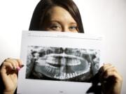 Liz Rowan, 21, holds a panoramic x-ray of her jaw Wednesday  in Vancouver. Doctors removed part of her jaw. At age 16, Liz Rowan was diagnosed with bone cancer in her jaw and blogged about her fight. Three years later, she was diagnosed with breast cancer -- the same thing that killed her mom. She had a double mastectomy and reconstructive surgery. She's still undergoing reconstructive surgery for her jaw.