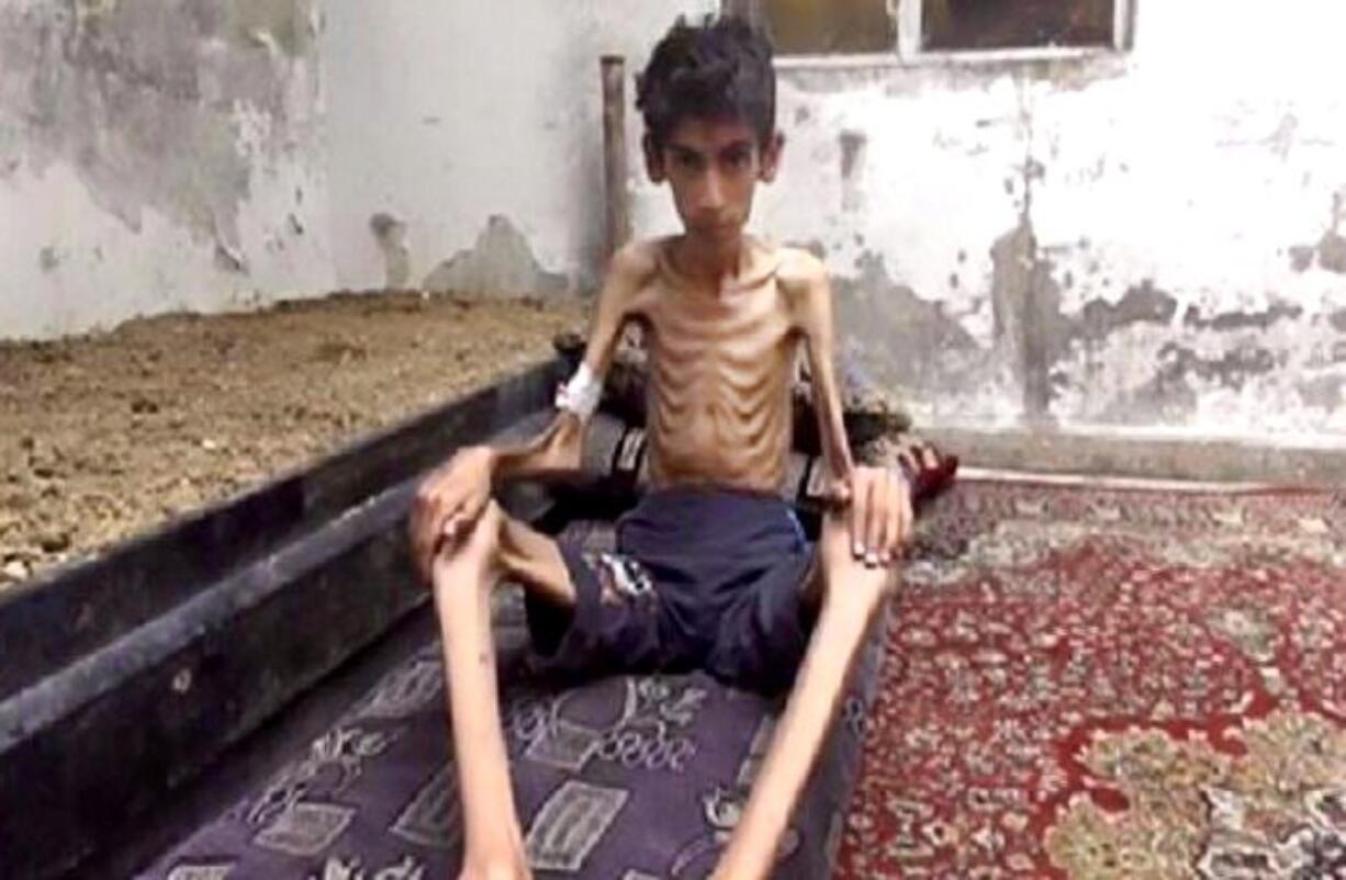 This undated photo posted by the Local Revolutionary Council in Madaya, which has been verified and is consistent with other AP reporting, shows a starving boy in Madaya, Syria, near the border with Lebanon.