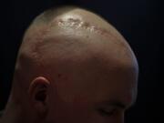 A scar from a brain surgery crosses Chase Sims&#039; head at Prestonwood Baptist Church on April 20 in Plano, Texas. (Jae S.