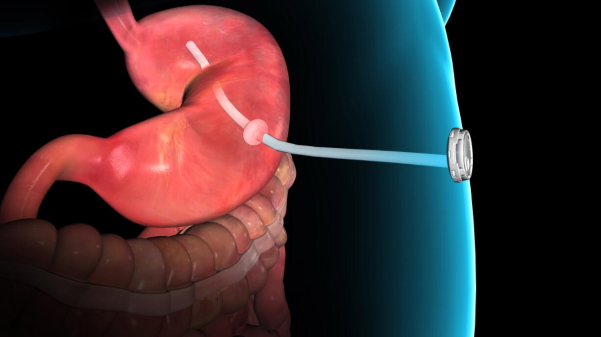 This rendering shows the AspireAssist system, a thin tube implanted in the stomach to remove nearly a third of the food stored in the stomach before its calories are absorbed.