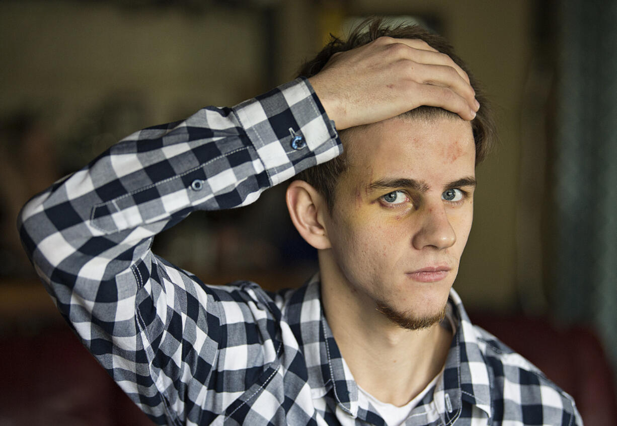 Assault survivor Josh Cooper, pictured Friday at his northeast Vancouver home, shows the wounds he suffered after a group of males beat him unconscious while he was walking to work Sunday night.