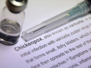 Chickenpox is an infectious disease causing a mild fever and a rash of itchy inflamed blisters.