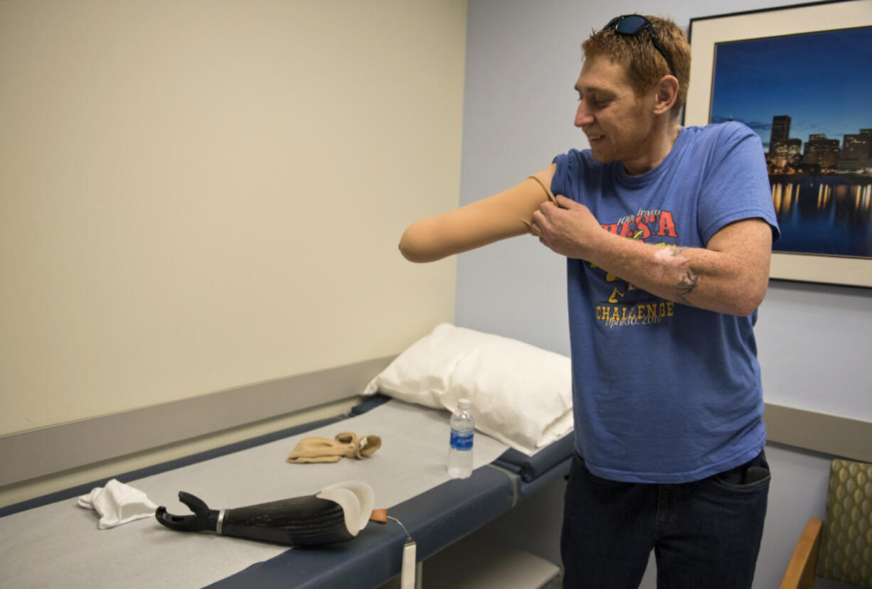 Travis O’Brien of Vancouver pulls on a sleeve before trying on his new prosthetic arm Oct. 27 at Evergreen Prosthetics & Orthotics in Vancouver. O’Brien’s arm was amputated Sept. 14 after an untreated broken arm led to an infection in his bone.