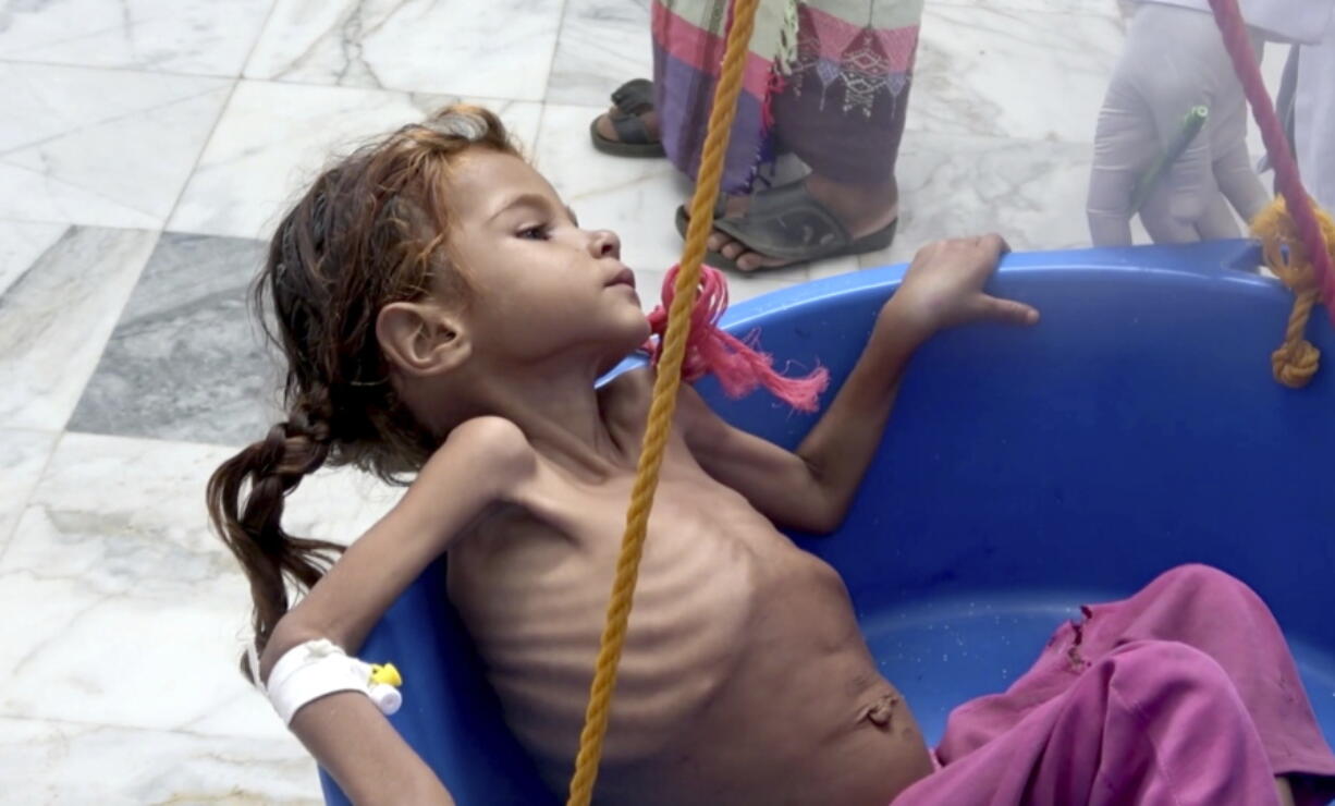 A severely malnourished seven-year-old Amal Hussein — whose name means “hope” in Arabic, is weighed at the Aslam Health Center in Hajjah, Yemen. On Sunday, Nov. 4, 2018, Geert Cappelaere called the situation a “living hell” for all Yemeni children, noting the death of Amal a child whose emaciated body gained attention on the front page of the New York Times last week.