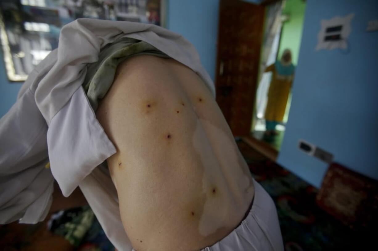 Kashmiri youth Gulam Rasool Bhat shows pellet wounds on his body inside his home in Srinagar, Indian controlled Kashmir, Tuesday, Aug. 20, 2019. The president of Pakistani-administered Kashmir welcomed efforts by U.S. President Donald Trump to lower tensions between Pakistan and India over the disputed Himalayan region on Tuesday and warned of a deepening humanitarian crisis and food shortages in the Indian-held portion.