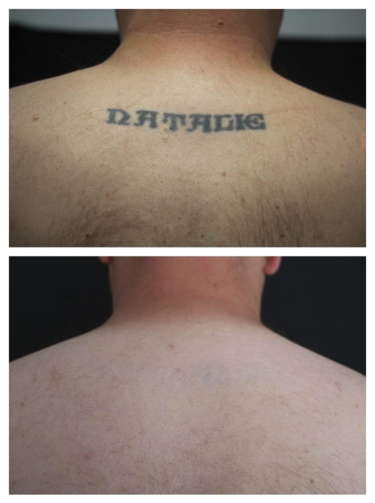 This combination of undated photos shows the back of patient Ryan Tucker before and after a series of laser tattoo removal procedures in Houston. Dr.