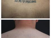 This combination of undated photos shows the back of patient Ryan Tucker before and after a series of laser tattoo removal procedures in Houston. Dr.