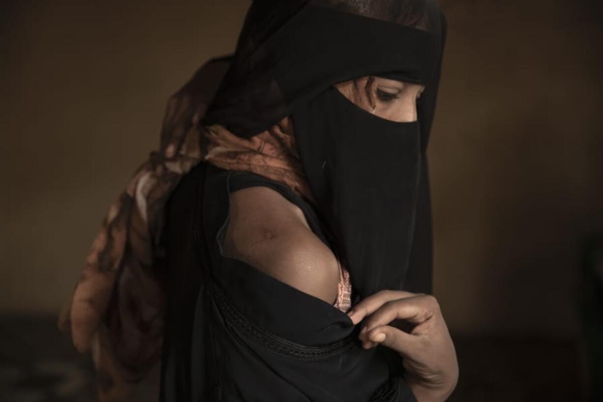 In this July 21, 2019 photo, Ethiopian migrant Eman Idrees shows her shoulder with a wound from torture after being held and abused for eight months in a desert compound known in Arabic as a &quot;hosh,&quot; run by an Ethiopian smuggler in Ras al-Ara, Lahj, Yemen.