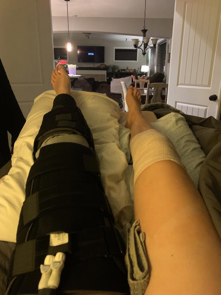 Image of Amelia Renner’s surgically repaired left knee after ACL surgery in November, when the doctor had to go into her right knee to graft a good hamstring ligament to rebuild her left ACL (Photo provided by Renner family)
