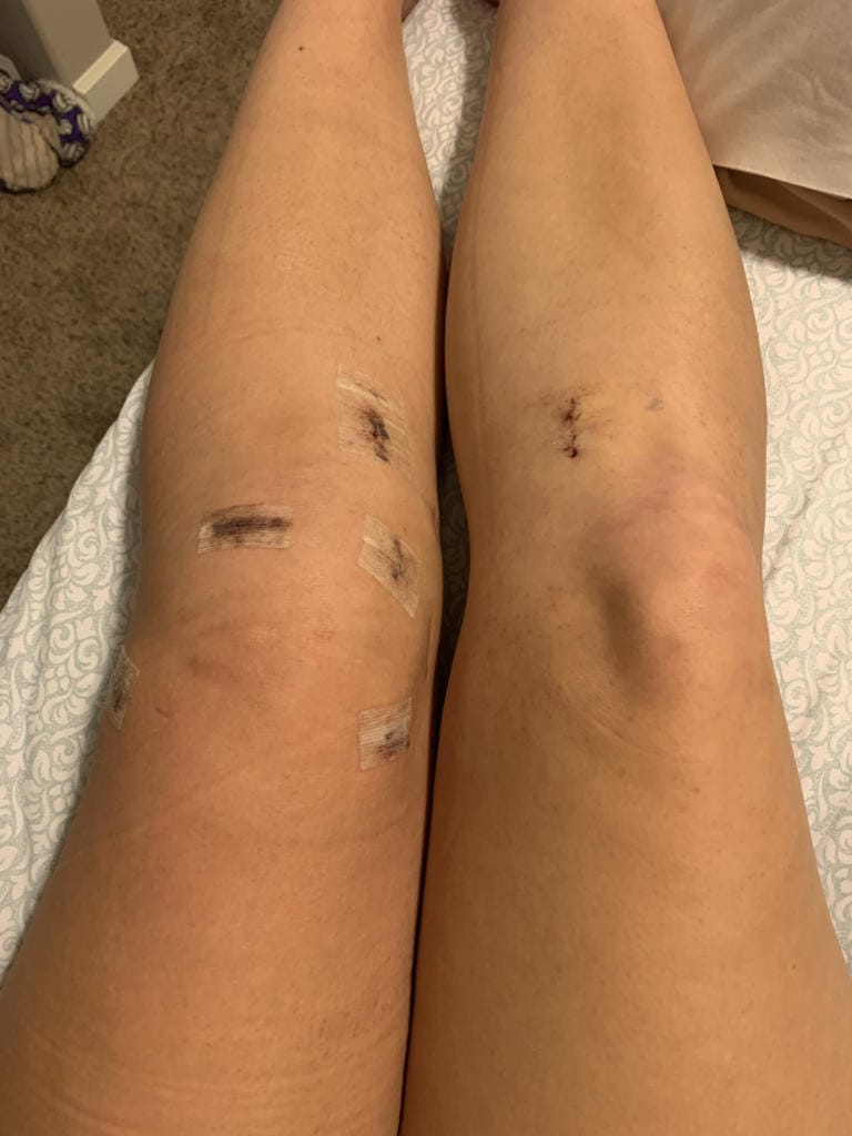 Amelia Renner’s knees after her second surgery to repair her left ACL by grafting a hamstring tendon from her right leg (Photo provided by Renner family)
