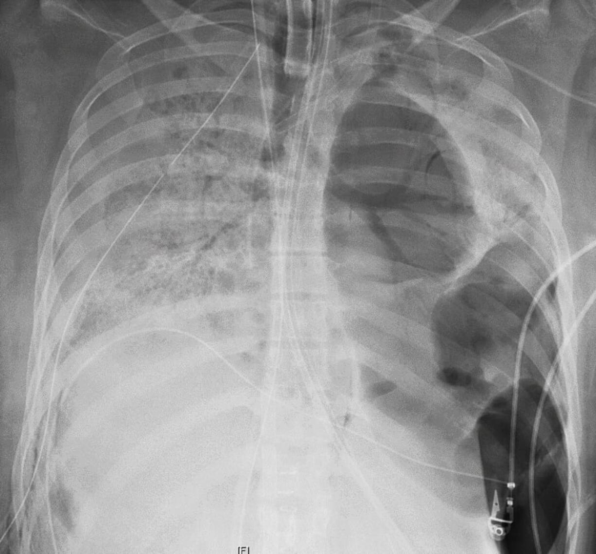 This X-ray image provided by Northwestern Medicine shows the chest of a COVID-19 patient before she received a new set of lungs on June 5 because of severe lung damage from the new coronavirus, at Northwestern Memorial Hospital in Chicago.