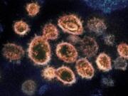 This 2020 electron microscope image provided by the National Institute of Allergy and Infectious Diseases — Rocky Mountain Laboratories shows SARS-CoV-2 virus particles isolated from a patient in the U.S., emerging from the surface of cells cultured in a lab.