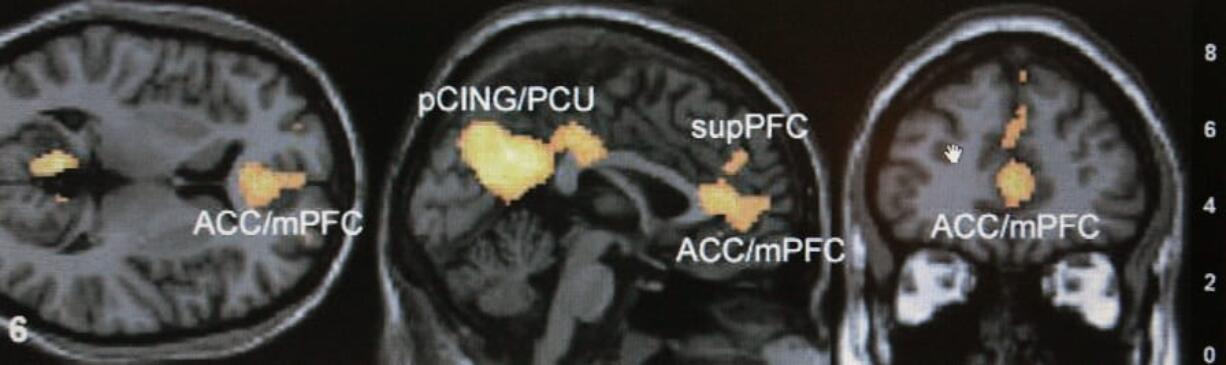 A functional magnetic resonance imaging scan on a computer screen at an Emory University lab in Atlanta. Using large magnets, the scans detect where oxygenated blood flows, allowing scientists to indirectly measure brain activity.