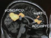 A functional magnetic resonance imaging scan on a computer screen at an Emory University lab in Atlanta. Using large magnets, the scans detect where oxygenated blood flows, allowing scientists to indirectly measure brain activity.