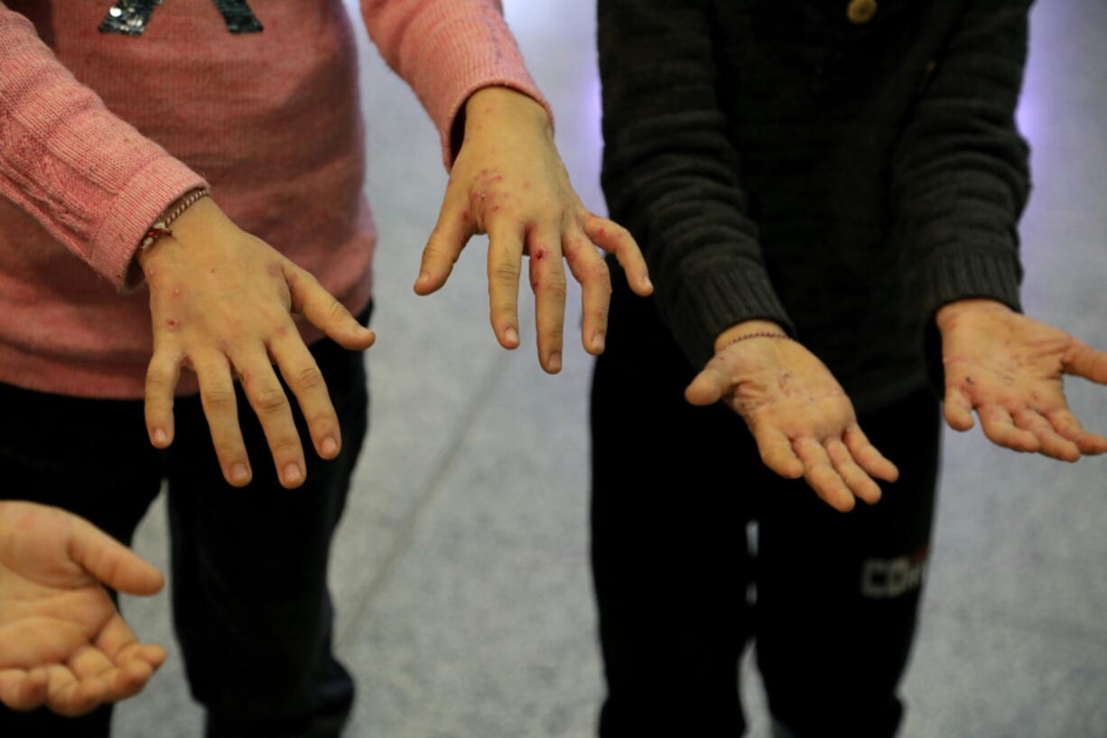 Children of the Iraqi migrants show hands with wounds and infections to the members of the media as they arrive to the airport in Irbil, Iraq, early Friday, Nov. 26, 2021. A second group of Iraqis have returned home in repatriation flights after a failed bid to enter Europe. Over 170 people returned on a flight that landed in Irbil airport in the northern Kurdish-run region Friday morning.