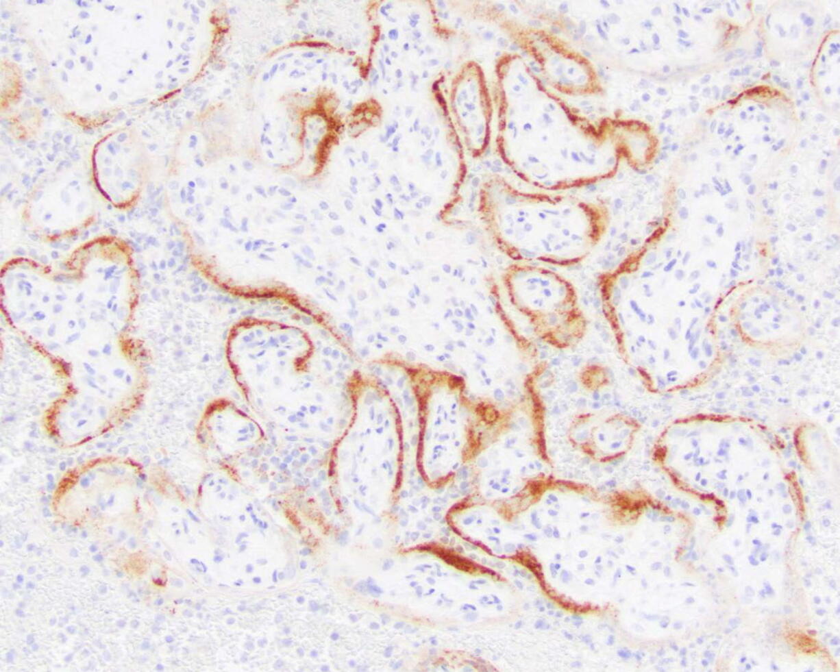 This microscope image provided by the College of American Pathologists and Archives of Pathology and Laboratory Medicine shows placental cells from a stillbirth with SARS-CoV-2 infection indicated by the darker stains. Research published on Thursday, Feb. 10, 2022 suggests the coronavirus can invade and destroy the placenta in a deadly process that may be a major cause of stillbirths in infected pregnant women.