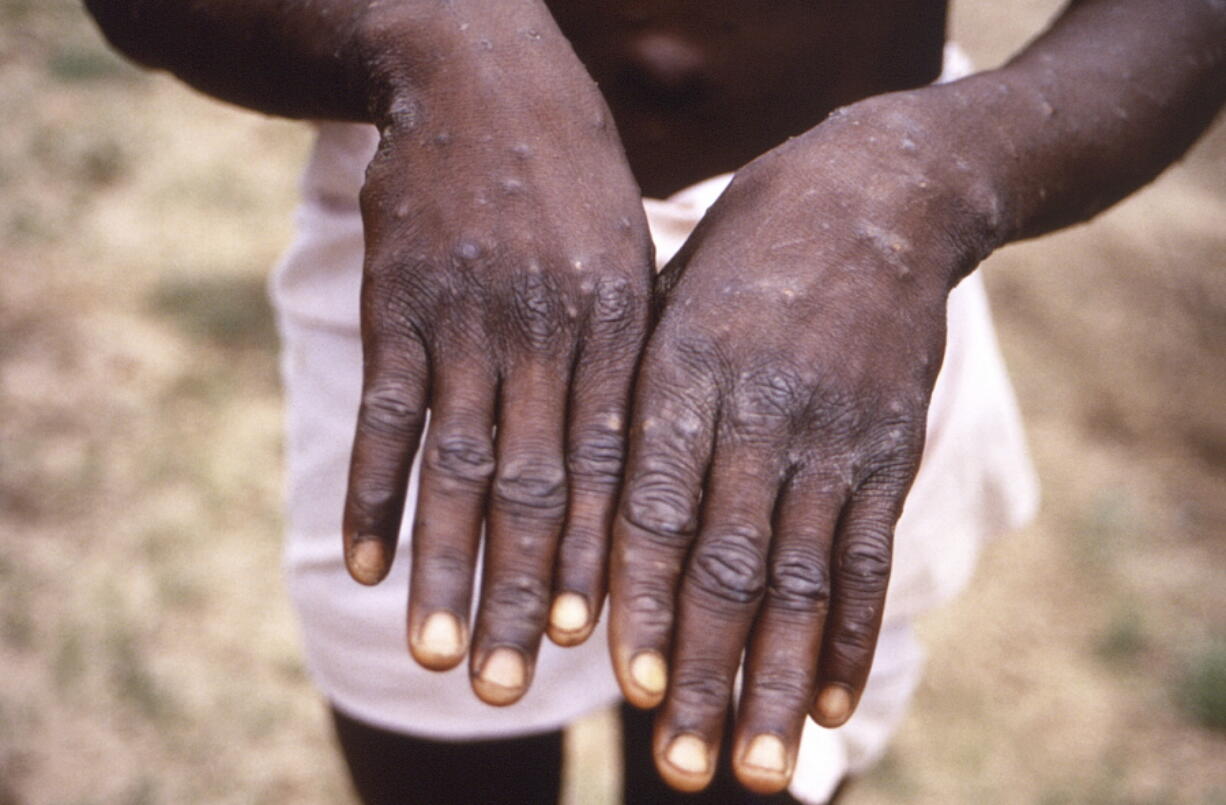 This 1997 image provided by the CDC  during an investigation into an outbreak of monkeypox, which took place in the Democratic Republic of the Congo (DRC), formerly Zaire, and depicts the dorsal surfaces of the hands of a monkeypox case patient, who was displaying the appearance of the characteristic rash during its recuperative stage. As more cases of monkeypox are detected in Europe and North America in 2022, some scientists who have monitored numerous outbreaks in Africa say they are baffled by the unusual disease's spread in developed countries.