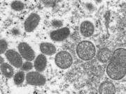 FILE - This 2003 electron microscope image made available by the Centers for Disease Control and Prevention shows mature, oval-shaped monkeypox virions, left, and spherical immature virions, right, obtained from a sample of human skin associated with the 2003 prairie dog outbreak. A leading doctor who chairs a World Health Organization expert group described the unprecedented outbreak of the rare disease monkeypox in developed countries as "a random event" that might be explained by risky sexual behavior at two recent mass events in Europe. (Cynthia S.