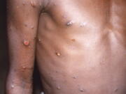 FILE - This 1997 image provided by U.S. Centers for Disease Control and Prevention shows the right arm and torso of a patient, whose skin displayed a number of lesions due to what had been an active case of monkeypox. As health authorities in Europe and elsewhere roll out vaccines and drugs to stamp out the biggest monkeypox outbreak beyond Africa, in 2022, some doctors are acknowledging an ugly reality: The resources to slow the disease's spread have long been available, just not to the Africans who have dealt with it for decades.