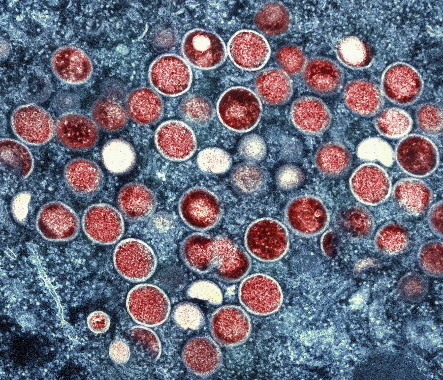 FILE - This image provided by the National Institute of Allergy and Infectious Diseases (NIAID) shows a colorized transmission electron micrograph of monkeypox particles (red) found within an infected cell (blue), cultured in the laboratory that was captured and color-enhanced at the NIAID Integrated Research Facility (IRF) in Fort Detrick, Md. With monkeypox cases subsiding in Europe and parts of North America in 2022, many scientists say now is the time to prioritize stopping the virus in Africa.