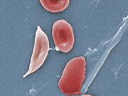 FILE - This 2009 colorized microscope image made available by the Sickle Cell Foundation of Georgia via the Centers for Disease Control and Prevention shows a sickle cell, left, and normal red blood cells of a patient with sickle cell anemia. A study of U.S. children with sickle cell disease found fewer than half get a needed screening for stroke, a common complication. And only about half or fewer get a treatment that can help with pain and anemia, the study found. The Centers for Disease Control and Prevention released the study Tuesday, Sept. 20, 2022, and called for more screening and treatment.