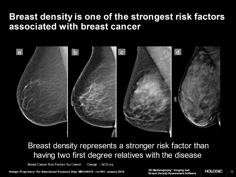 Do dense breasts affect the risk of developing breast cancer