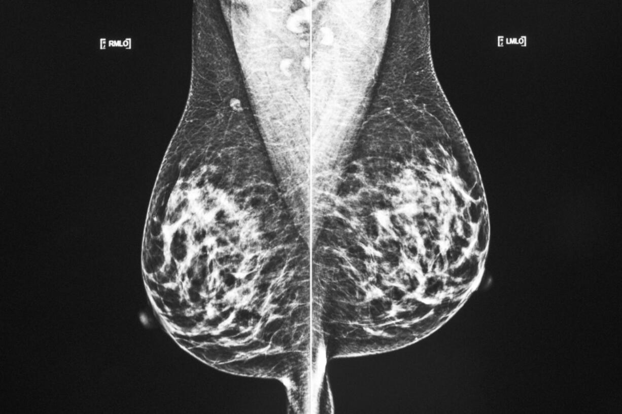 FILE - A technician displays images of a mammogram scan on a computer screen at a hospital in Odessa, Texas, on Wednesday, Oct. 20, 2021. A study discussed Friday, Dec. 9, 2022, at the San Antonio Breast Cancer Symposium finds many women with two or three breast tumors can get by with lumpectomy surgery instead of having their whole breast removed.