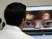 Dr. Alfonso Sabater, left, pulls up photos of Antonio Vento Carvajal's eyes photographed before and after surgery and gene therapy, Thursday, July 6, 2023, at University of Miami Health System's Bascom Palmer Eye Institute in Miami. Antonio was born with dystrophic epidermolysis bullosa, a rare genetic condition that causes blisters all over his body and in his eyes. He was blind for much of his life but can see again after getting gene therapy eyedrops.