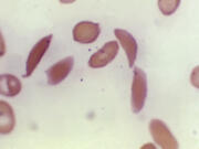 FILE - This microscope photo provided on Oct. 25, 2023, by the Centers for Disease Control and Prevention shows crescent-shaped red blood cells from a sickle cell disease patient in 1972. Britain&rsquo;s medicines regulator has authorized the world&rsquo;s first gene therapy treatment for sickle cell disease, in a move that could offer relief to thousands of people with the crippling disease in the U.K. In a statement on Thursday, Nov. 16, 2023, the Medicines and Healthcare Regulatory Agency said it approved Casgevy, the first medicine licensed using the gene editing tool CRISPR, which won its makers a Nobel prize in 2020.   (Dr. F.