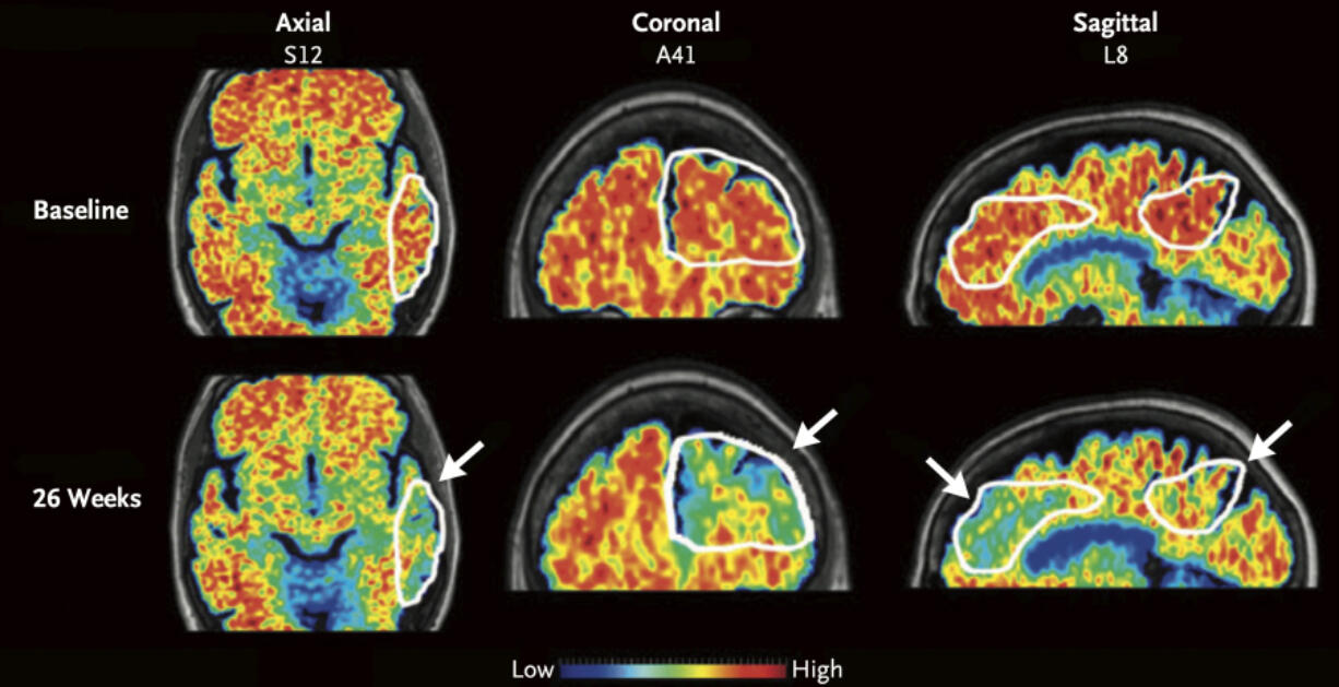 These PET scan images provided by the New England Journal of Medicine in January 2024 show a reduction in amyloid-beta levels in an Alzheimer&rsquo;s patient after focused ultrasound treatment to open the blood-brain barrier after 26 weeks. Red is associated with higher levels of amyloid-beta levels. Scientists have found a way to help Alzheimer&rsquo;s drugs seep inside the brain faster _ by temporarily breaching its protective shield.