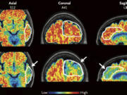 These PET scan images provided by the New England Journal of Medicine in January 2024 show a reduction in amyloid-beta levels in an Alzheimer&rsquo;s patient after focused ultrasound treatment to open the blood-brain barrier after 26 weeks. Red is associated with higher levels of amyloid-beta levels. Scientists have found a way to help Alzheimer&rsquo;s drugs seep inside the brain faster _ by temporarily breaching its protective shield.