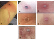 This image provided by the Alaska Department of Health shows several Alaskapox lesions. &ldquo;A&rdquo; is a lesion about 10 days after symptom onset, and &ldquo;B&rdquo; is the same lesion two days later. &ldquo;C&rdquo; is a lesion about 5 days after symptom onset, about 1.2 cm across. &ldquo;D&rdquo; is a lesion about 5 days after symptom onset, about 1 cm across, and &ldquo;E&rdquo; is same lesion about 4 weeks after symptom onset. &ldquo;F&rdquo; is a lesion around the reported symptom onset date. Alaskapox belongs to a family of viruses that can infect animals and humans, known as orthopoxviruses, which tend to cause lesions, or pox, on the skin.