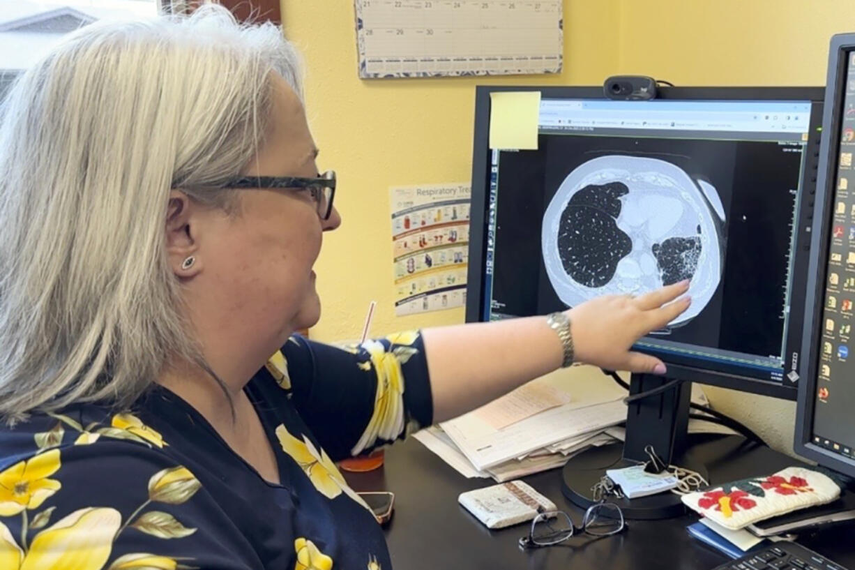 FILE - Dr. Lee Morissette shows an image of lungs damaged by asbestos exposure, at the Center for Asbestos Related Disease, Thursday, April 4, 2024, in Libby, Mont. BNSF Railway attorneys are expected to argue before jurors Friday, April 19, 2024, that the railroad should not be held liable for the lung cancer deaths of two former residents of the asbestos-contaminated Montana town, one of the deadliest sites in the federal Superfund pollution program.