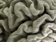 FILE - A section of a human brain with Alzheimer&rsquo;s disease is displayed at the Museum of Neuroanatomy at the University at Buffalo, in Buffalo, N.Y., Oct. 7, 2003. A long-feared gene appears to do more than raise people&Ccedil;&fnof;&Ugrave;s risk of Alzheimer&Ccedil;&fnof;&Ugrave;s: Inheriting two copies can cause the mind-robbing disease, according to research published in the journal Nature Medicine on Monday, May 6, 2024.