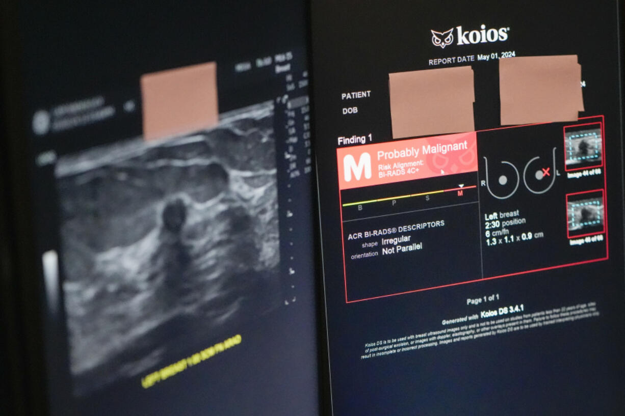 The Koios DS Smart Ultrasound software, used to get a second opinion on mammography images, is seen on a computer screen, Wednesday, May 8, 2024, at Mount Sinai hospital in New York. In the near term, experts say AI will work like autopilot systems on planes &mdash; performing important navigation functions, but always under the supervision of a human pilot.
