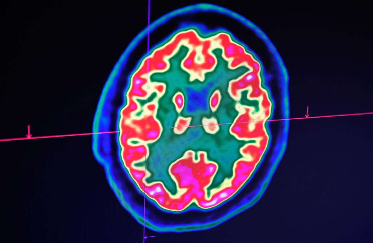 A picture of a human brain taken by a positron emission tomography scanner, also called PET scan, is seen on a screen on Jan. 9, 2019, at the Regional and University Hospital Center of Brest, western France. At Boston University, researchers have designed a new AI computer program that identifies those with mild cognitive impairment who are likely to develop Alzheimer&thorn;&Auml;&ocirc;s within six years.