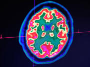A picture of a human brain taken by a positron emission tomography scanner, also called PET scan, is seen on a screen on Jan. 9, 2019, at the Regional and University Hospital Center of Brest, western France. At Boston University, researchers have designed a new AI computer program that identifies those with mild cognitive impairment who are likely to develop Alzheimer&thorn;&Auml;&ocirc;s within six years.