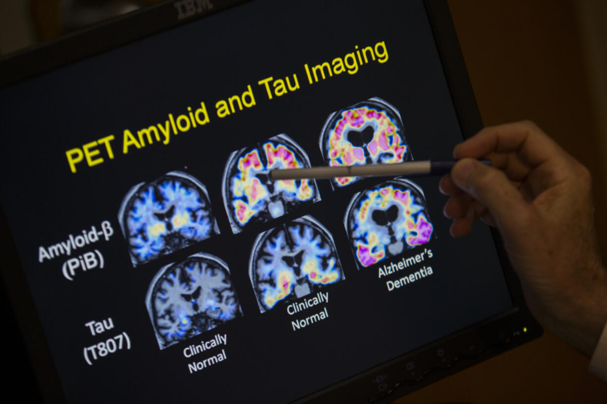 FILE - A doctor points to PET scan results that are part of a study on Alzheimer&#039;s disease at Georgetown University Hospital, on Tuesday, May 19, 2015, in Washington.