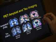 FILE - A doctor points to PET scan results that are part of a study on Alzheimer&#039;s disease at Georgetown University Hospital, on Tuesday, May 19, 2015, in Washington.